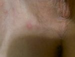 Female Genital Herpes HSV-1