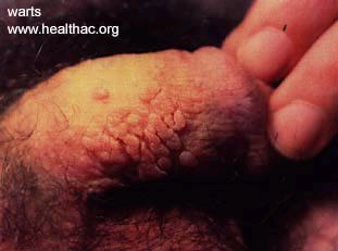 http://www.herpes-coldsores.com/std/std_images/genital_warts2.gif